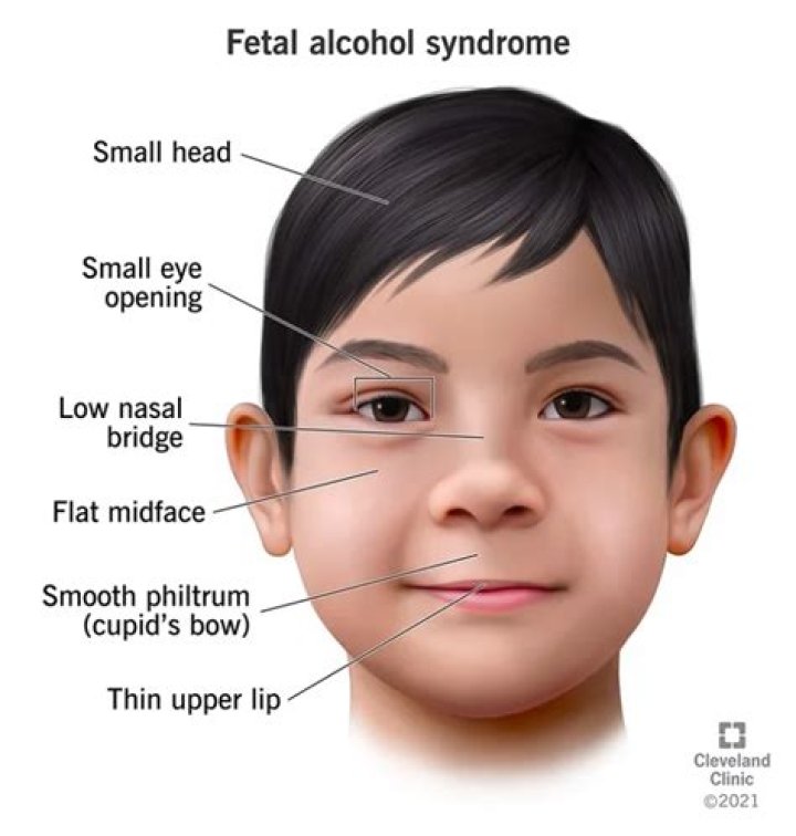 Unlocking The Truths Behind Bella Ramsey Fetal Alcohol Syndrome
